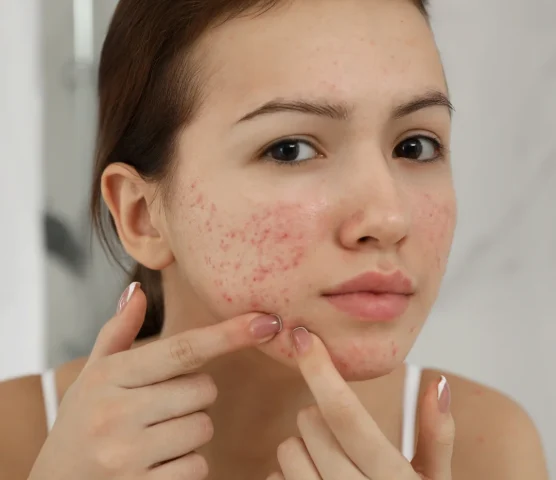 Atopic-dermatitis-67.webp